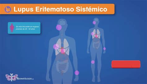 ¿qué Es El Lupus Eritematoso Sistémico Reumátologos Mx