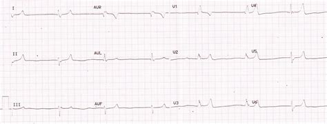 ECG in hyperkalemia – All About Cardiovascular System and Disorders