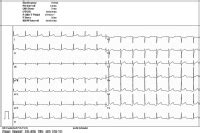 Abbildungen und Graphiken Bilder der Herzchirurgie Trügerischer AV Block