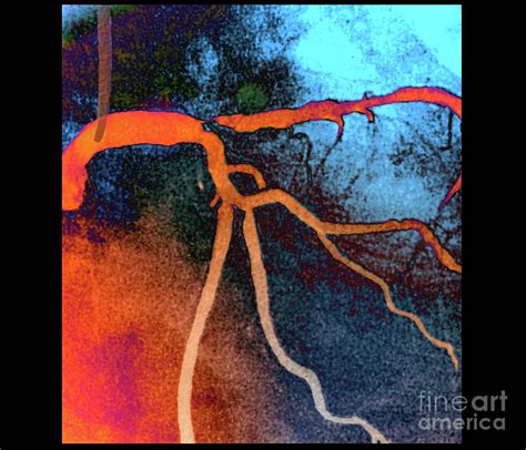 coronary artery stenosis photograph  zephyrscience photo library pixels