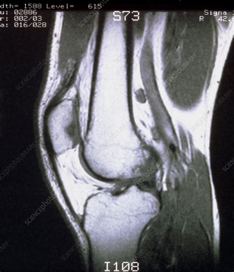 Mri Scan Knee Images