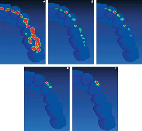 Scielo Brasil Effect Of Prosthodontic Planning On Lateral Occlusion