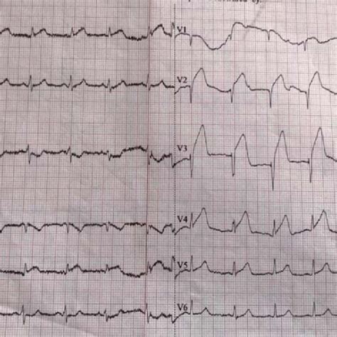 Initial emergency room ECG: normal sinus rhythm, ST-segment elevation ...