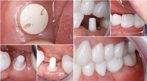 Zirconium Implants Holistic Dentistry In Costa Rica Natural Dental