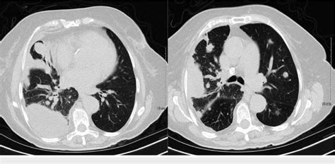 Ct Of The Chest Without Contrast Left Figure Large Loculated Right