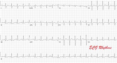 Ecg Rhythms Pulmonary Embolism