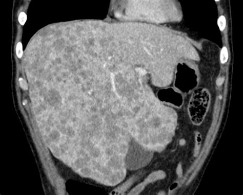 Liver Atlas Diagnosis Metastasis Prostate Cancer