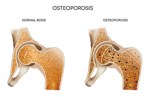 Osteoporosis Definition Symptoms Best Treatments VIP Medical Group