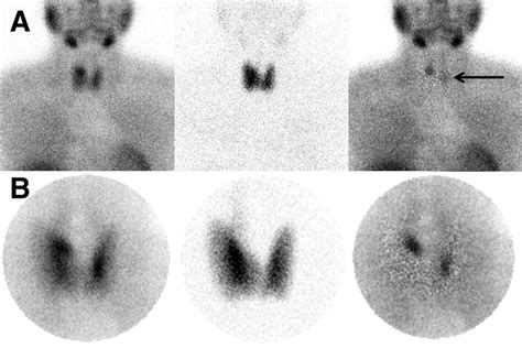 Primary Hyperparathyroidism Defining The Appropriate Preoperative