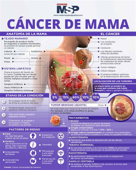 Cáncer de seno Infografía