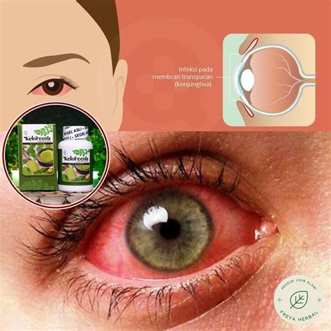 Jual Obat Konjungtivitis Obat Konjungtiva Mata Obat Radang Selaput