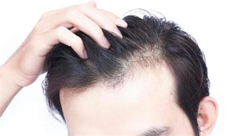 Hair Loss Causes Prevention And Treatment