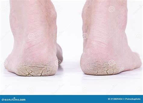 Diabetic Foot, Feet Cracked Heels Legs of a Person Stock Photo - Image ...