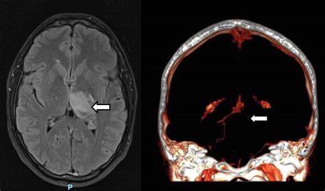 A Unilateral Thalamic Lesion Referred For Biopsy Journal Of Clinical