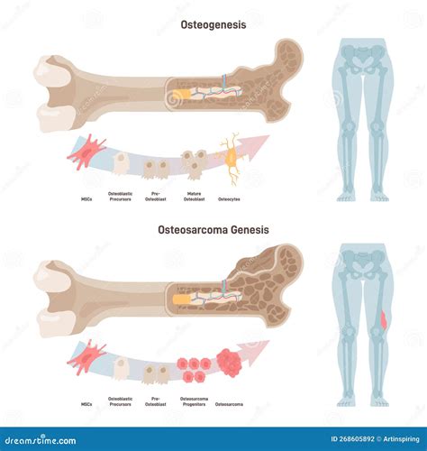 Osteosarcoma Bone Tumor As Osteogenic Sarcoma Skeleton Cancer Outline