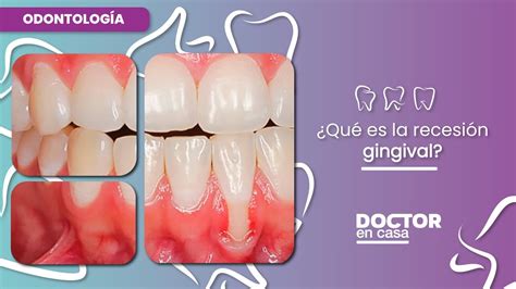 Clasificación De La Recesión Gingival