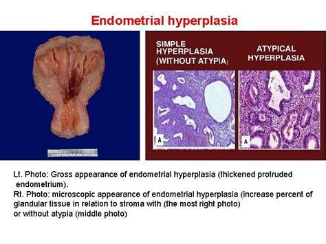 Female Genital Tract Dr Basim Shehab Ahmed Koilocytosis