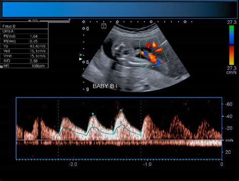 430+ Ultrasound Twins Stock Photos, Pictures & Royalty-Free Images - iStock