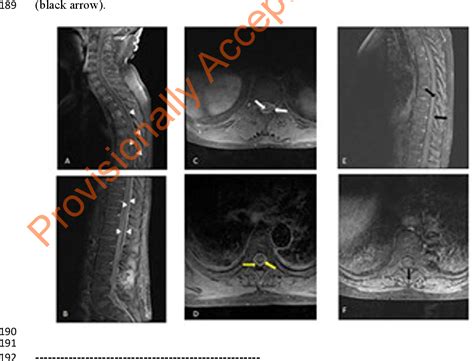 Figure 1 From Spinal Stenosis Caused By Epidural And Paraspinal Abscess