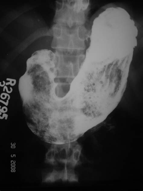 Barium Meal Upper Gi Series Showing Mottled Filling Def Open I