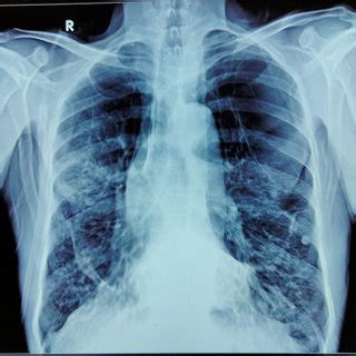 Chest Radiograph Posterior Anterior View Showing Hyperlucent Lung