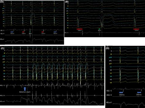 A Surface Electrogram And Intracardiac Electrogram Recorded By The