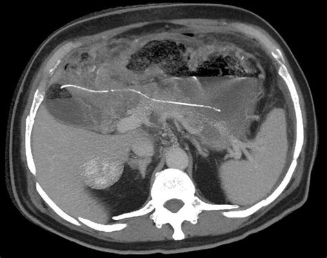 Ectopic Pancreatic Stent Ct Scan Photograph By Du Cane Medical Imaging