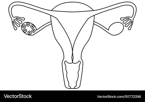 Diagrammatic Of Polycystic Ovary Syndrome Vector Image