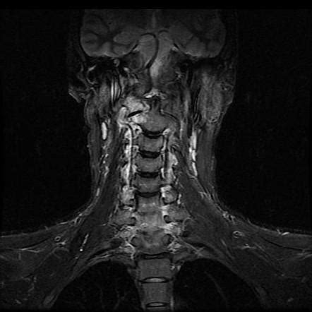 Cervical Spine Meningioma Radiology Case Radiopaedia Org