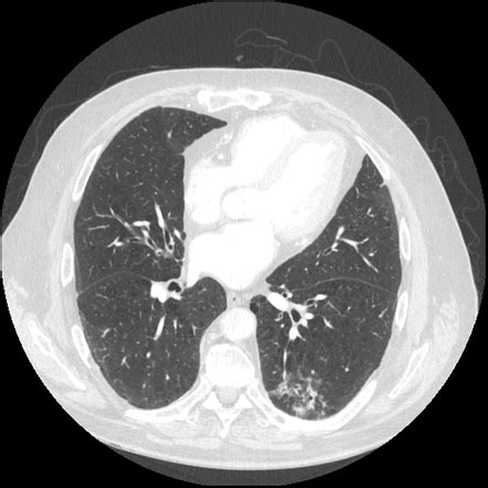 Lung Adenocarcinoma Radiology Case Radiopaedia Org