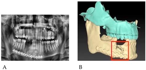 Reports Free Full Text Secondary Treatment Of Mandibular Bone