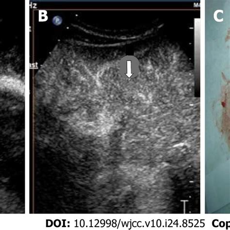 Representative Images Of Contrast Enhanced Ultrasound And Pathological