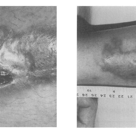 Lesion after treatment. | Download Scientific Diagram