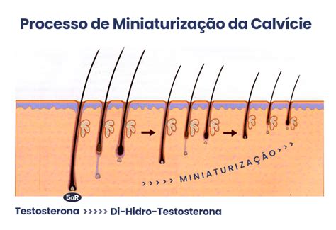 Alopecia Androgenética O que é Dr Lucas Madureira