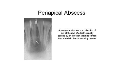 Periapical Pathology Pap Periapical Abscess Granuloma Periodontal Cyst