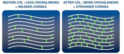 Corneal Cross-Linking – Lake Austin Eye