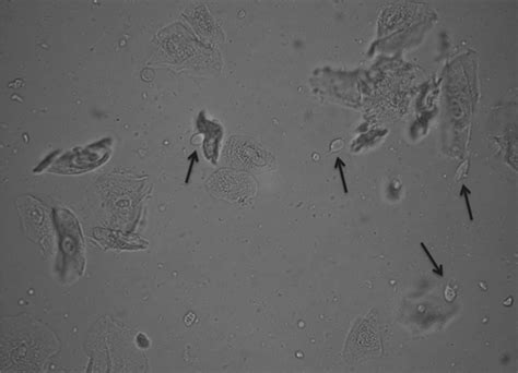 The Clinical Spectrum Of Trichomonas Vaginalis Infection And Challenges To Management Sexually