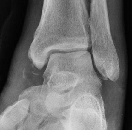 Avulsion injury | Radiology Reference Article | Radiopaedia.org