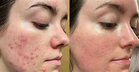 5 Weeks Into My Accutane Journey And I Can’t Believe This Is My Skin Imgur