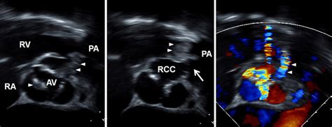 Transesophageal Echocardiogram A B Short Axis View Of The Aortic Download Scientific Diagram