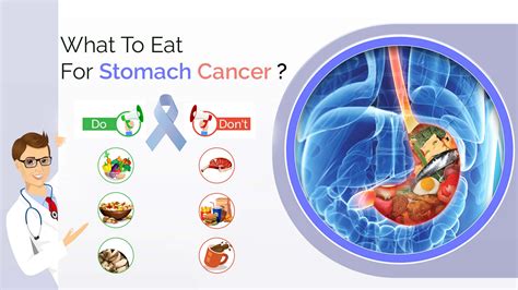 Stomach Cancer Stages