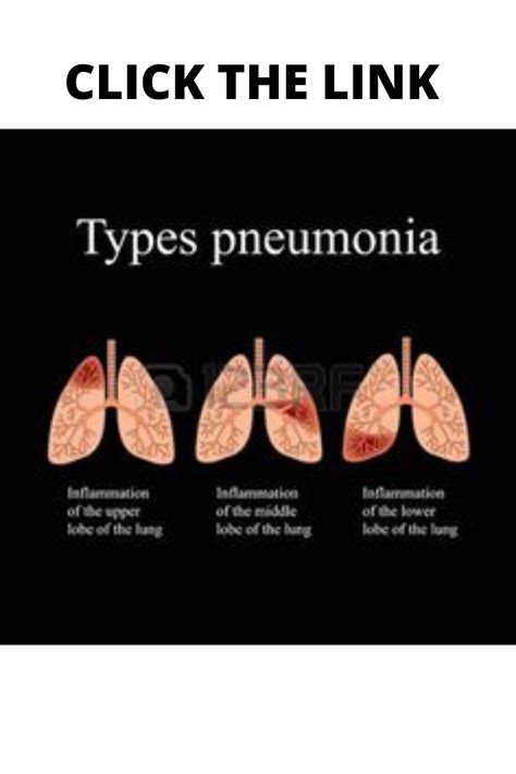 Types Pneumonia In 2021 What Is Pneumonia Pneumonia