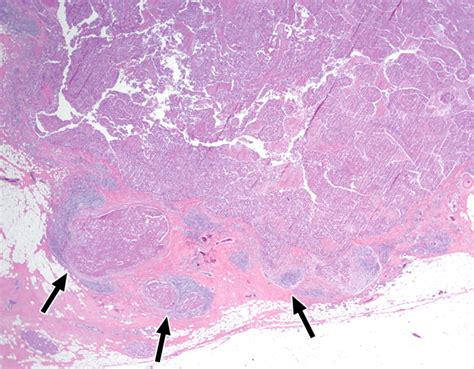 Medullary Carcinoma Of The Breast Mri Findings Ajr