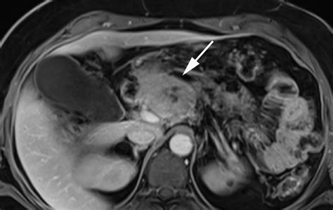 Pancreatic Neuroendocrine Neoplasms 2020 Update On Pathologic And