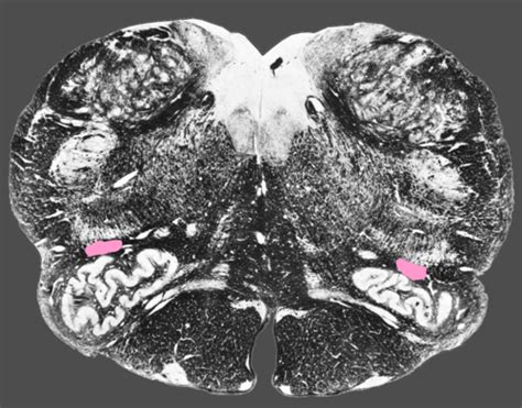 upper  medulla flashcards quizlet