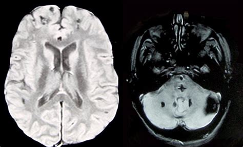 Axial Mri T2 Weighted Gradient Echo Sequence Images Show Supratentorial