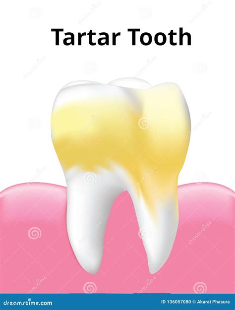 Tartar Tooth With Gum Isolated On White Background Stock Illustration