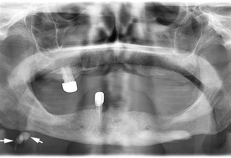 Sialoliths Of Submandibular Gland And Whartons Duct Orthopantomography