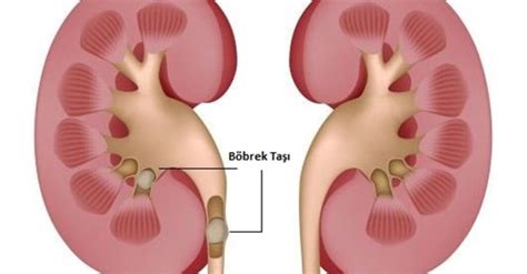 Böbrek Taşı Nasıl Düşer Taş Düşürme Belirtileri