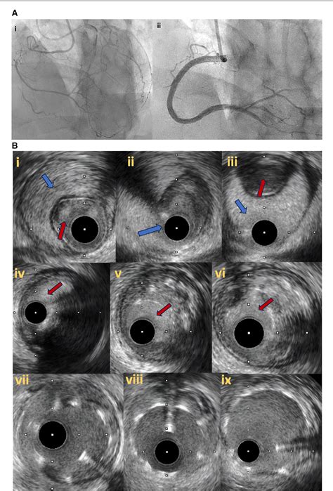 Figure From The Role Of Intravascular Imaging In Chronic Total